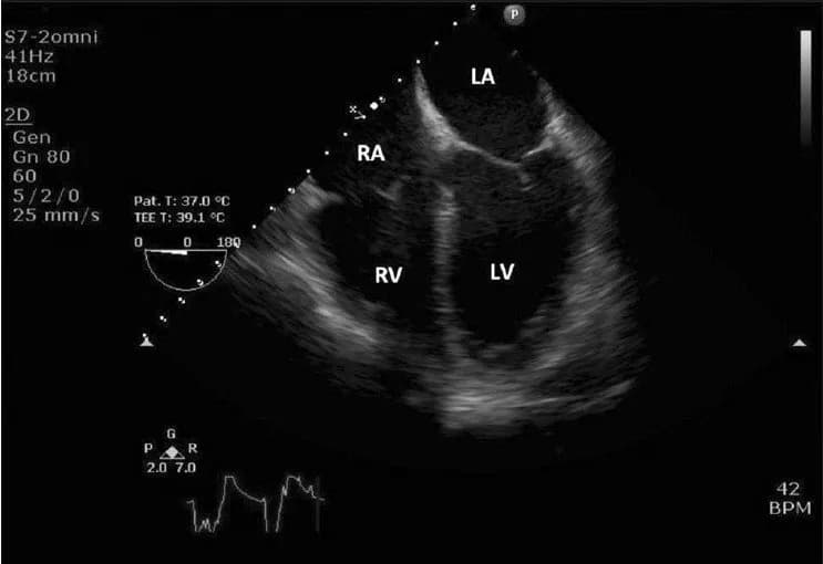 Chỉ định và chống chỉ định siêu âm tim qua đường thực quản