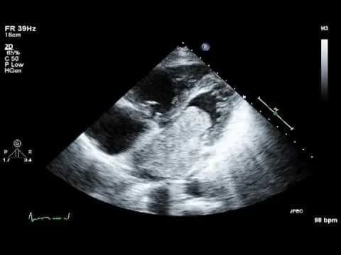 Tổng quan về bệnh U nhày nhĩ (Atrial Myxoma)