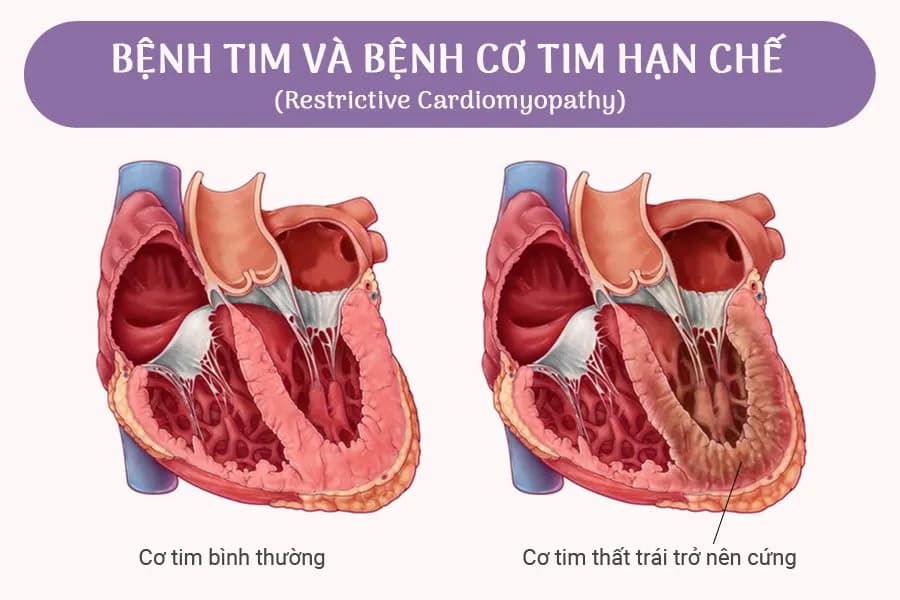 Bệnh cơ tim hạn chế: Nguyên nhân, triệu chứng
