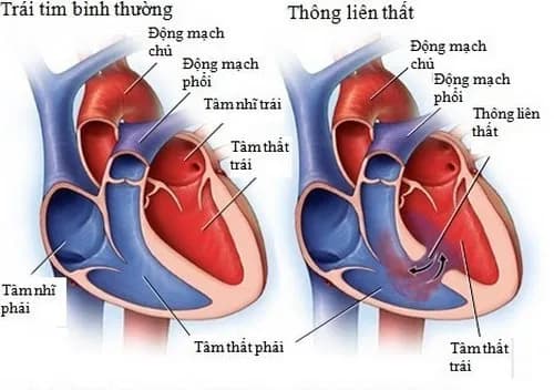 Bệnh tim thông liên thất có nguy hiểm không