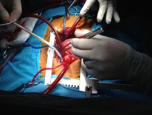 Bệnh tim bẩm sinh không tím không luồng thông