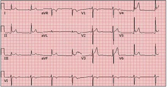 Cảnh giác với tái cực sớm ở tim