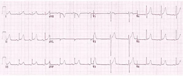 Cảnh giác với tái cực sớm ở tim