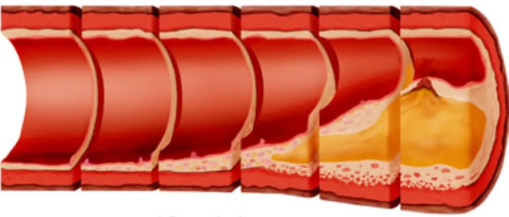 Quá trình tiến triển của xơ vữa động mạch