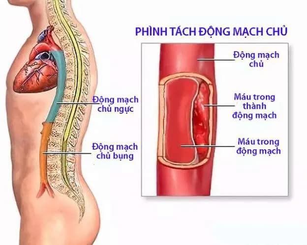 Phẫu thuật điều trị hẹp eo động mạch chủ