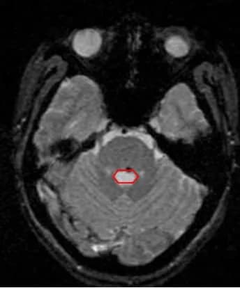 U máu thể hang: Một dị dạng mạch não