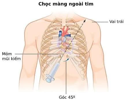 Sốc tim điều trị và theo dõi thế nào?