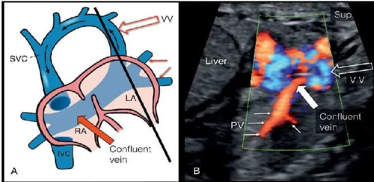 Bất thường tĩnh mạch phổi trở về hoàn toàn