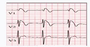 Những câu hỏi thường gặp về Hội chứng Brugada