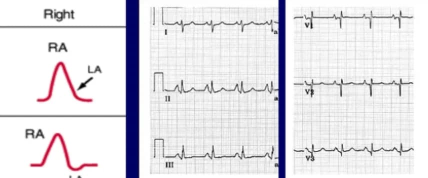 Sóng P là gì? Các dạng sóng P của điện tâm đồ