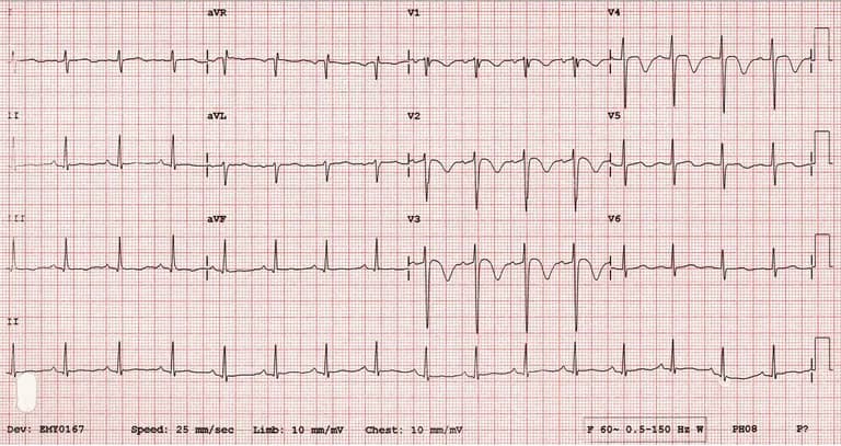 Hình dạng và cơ chế hình thành các sóng trên điện tâm đồ