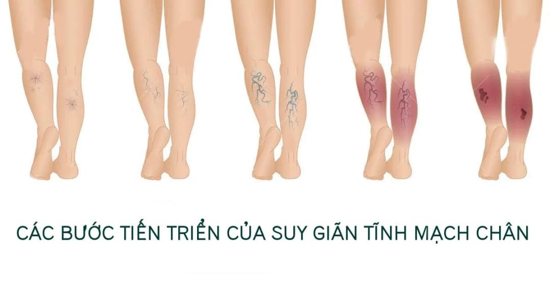 Điều trị suy giãn tĩnh mạch chi dưới bằng laser