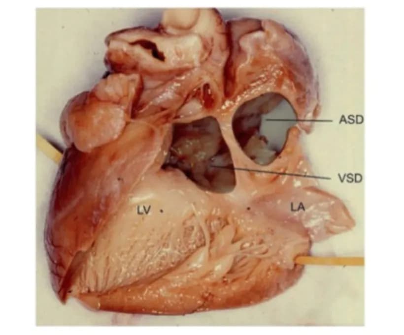 Tìm hiểu thông tin về kênh nhĩ thất