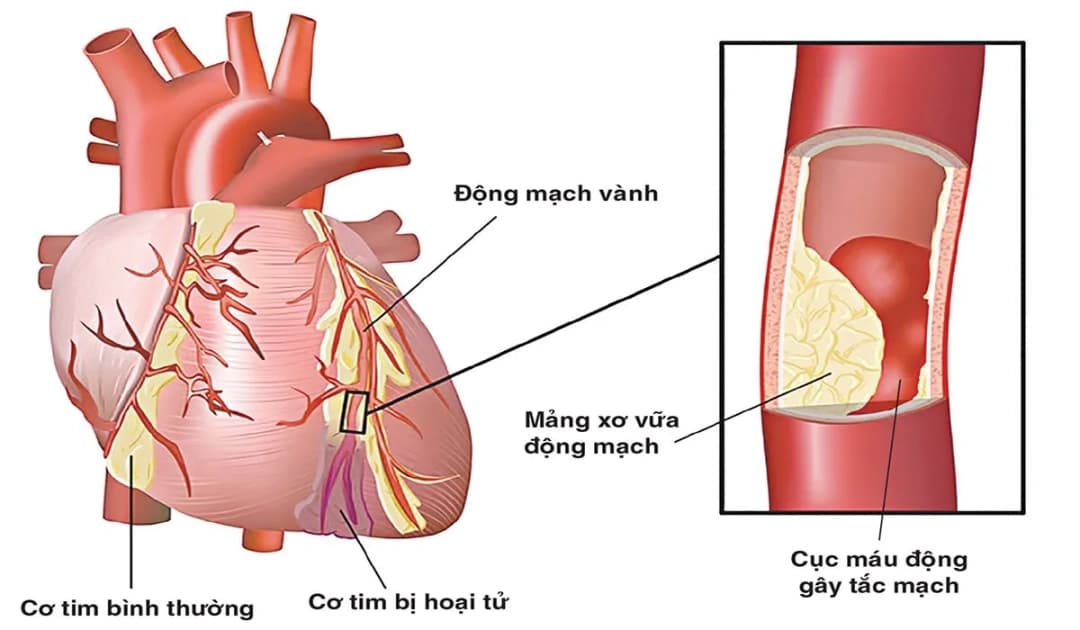 Vai trò của protein phản ứng C (CPR) trong xơ vữa động mạch