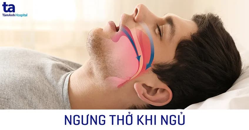 Ngưng thở khi ngủ và những nguy cơ với sức khỏe