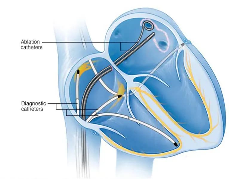 Cắt đốt bằng ống thông điều trị bệnh tim mạch