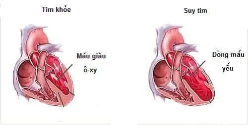 Phòng và điều trị bệnh suy tim ở người cao tuổi 2