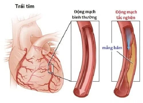 Bệnh động mạch vành là nguyên nhân dẫn đến suy tim trái