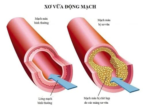 Có phải Cholesterol nào cũng gây xơ vữa động mạch? 2