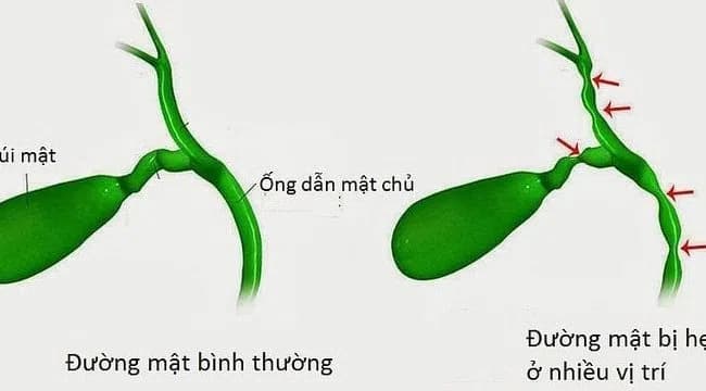 Bệnh teo đường mật bẩm sinh