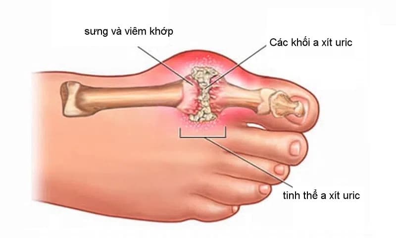 Bệnh gout