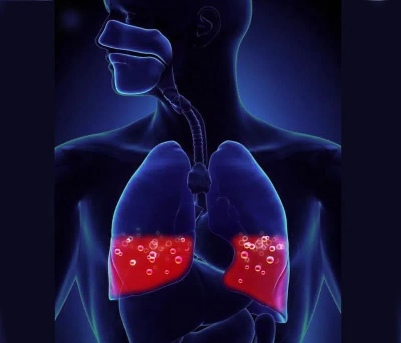 Bệnh Thuyên tắc phổi là gì?