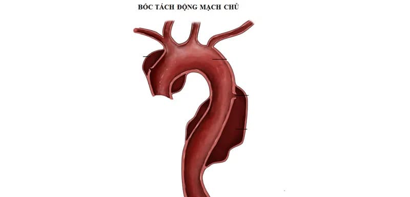 Bóc tách động mạch chủ là gì?