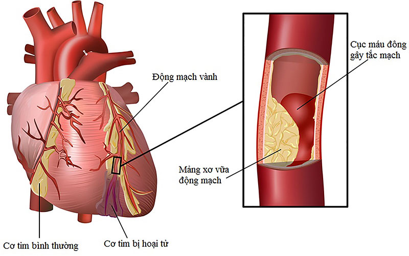Bệnh thiếu máu cơ tim Bệnh thiếu máu cơ tim